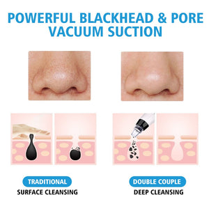 Blackhead Remover Vacuum